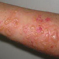 Воспаления кожи