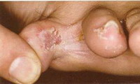 Грибковые заболевания кожи (лечение)