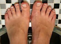 Грибковые заболевания на пальцах ног